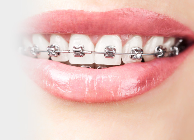  Fixed metal braces