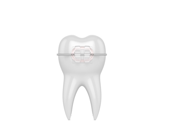  Clear ceramic braces