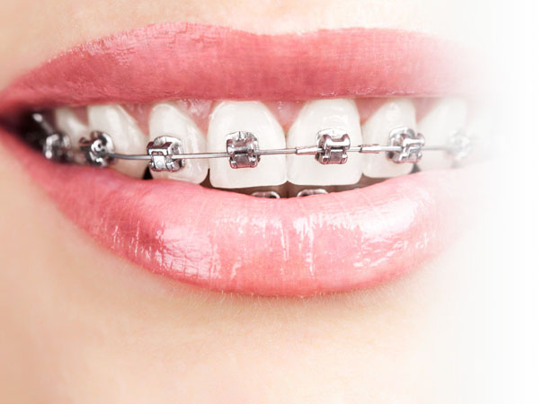  Fixed metal braces